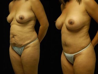 Tummy Tuck and Breast Augmentation after 392095