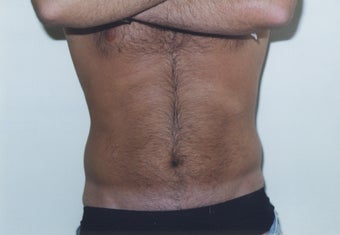 Liposuction before 211938