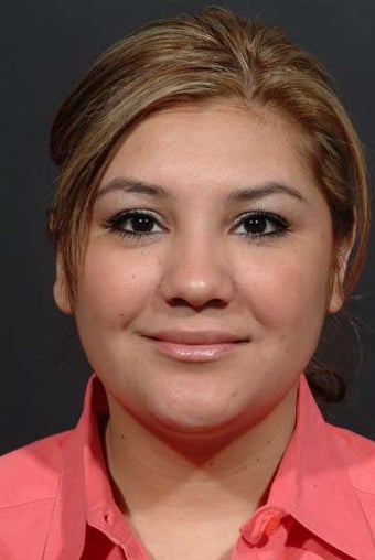 Otoplasty after 292474