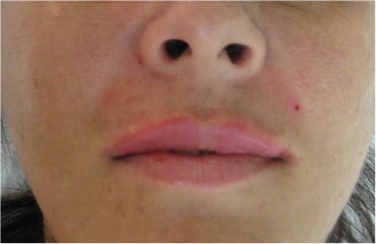Juvederm for upper lip and nasolabial folds after 77460