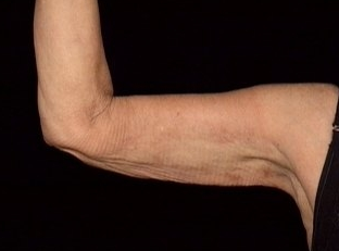 Arm Lift after 230667