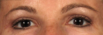 Upper Eyelidplasty with TCA Peel Lower Lids after 420542