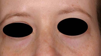 Blue veins around eyes after 135045