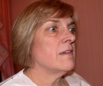 Facelift, Neck lift, Blepharoplasty before 182883