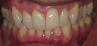 Cosmetic bonding and gum lift before 457034
