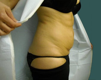 Tummy tuck 561249