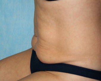 Local Anaesthetic Tummy Tuck 344435