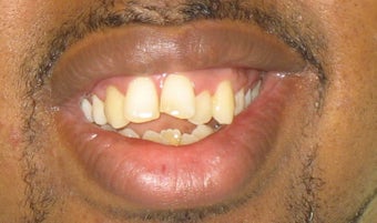Braces: correction of openbite and dental crowding before 346378