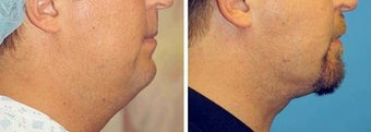 Chin Liposuction before 640738