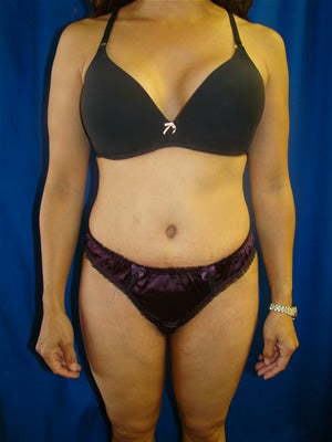 Tummy Tuck Surgery (Abdominoplasty) after 105128