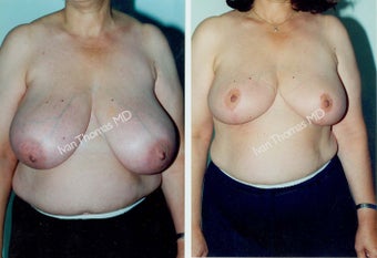 Breast Reduction before 243752