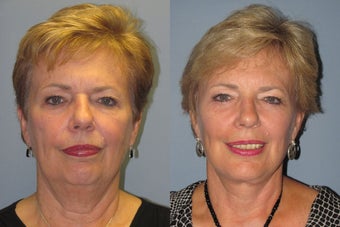 Lite Lift™, liposuction of the neck, lower eyelid lift after 523518