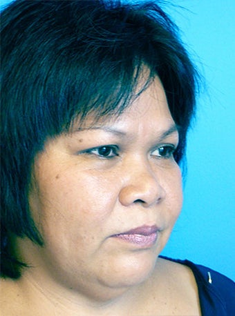 Rhinoplasty before 177462