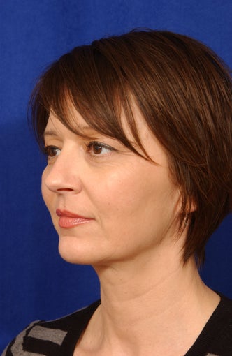 Neck-lace with anatomic chin implant after 279557