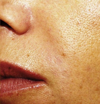 Sculptra after 197939