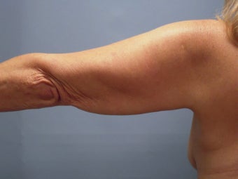 Liposuction 581446