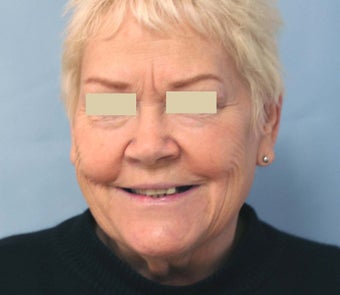 Porcelain crowns before 109195