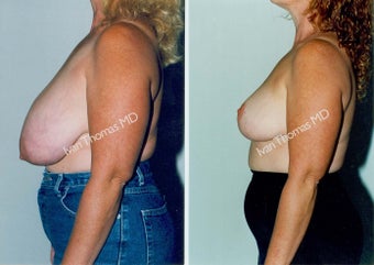 Breast Reduction before 243747