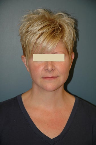 Neck lift after 137775