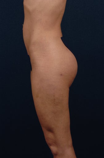Brazilian Buttock Lift after 269886
