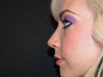 Rhinoplasty after 267942