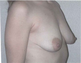 Breast lift with augmentation 633947