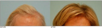 Female Hair Transplant before 134758