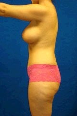 Tummy Tuck (Abdominoplasty), Breast Enhancement 429758