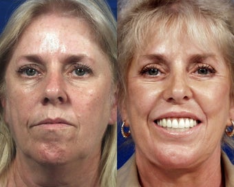 Botox with Facelift, Rhinoplasty, Laser Resurfacing, and Dermal Fillers before 555016