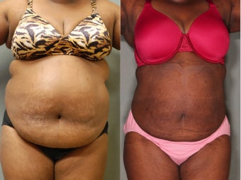 37 Year old Female Loses 14" Upper Lower Abs before 631174