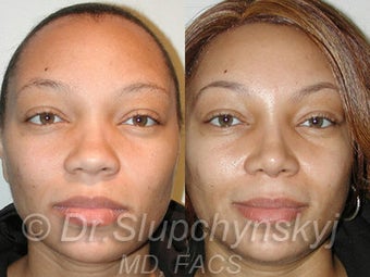 African American Rhinoplasty before 525580