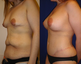 Lower Body lift, Breast Augmentation after 543105