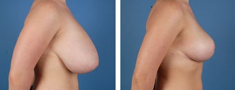 Breast Reduction before 355748