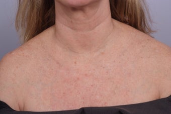decollete laser resurfacing after 253111