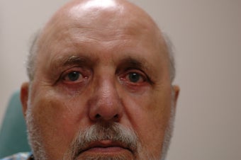 Lower eyelid surgery or lower blepharoplasty after 366300