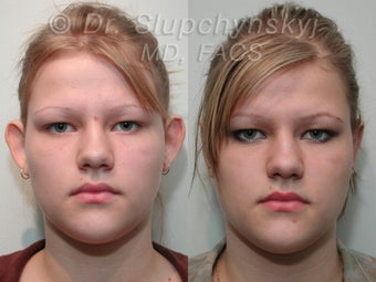 Otoplasty (Ear surgery) before 565733