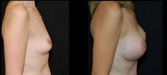 Breast Implants 150816