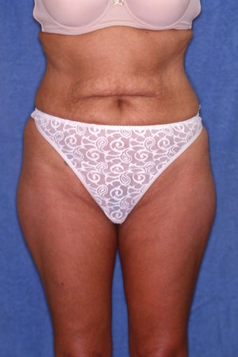 Tummy Tuck with Liposuction before 411589