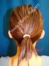 Ear Surgery (Otoplasty) 579104