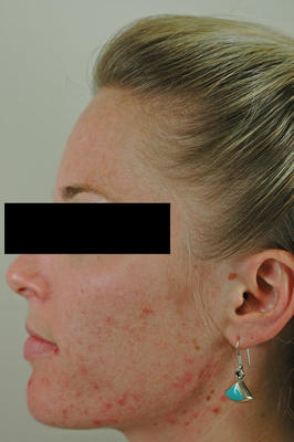 Laser Acne Treatment before 82951