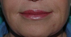 Lip Augmentation with Restylane after 118311