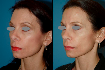 Revision Rhinoplasty (open) 306788