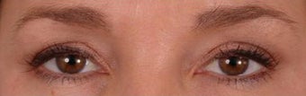 Eyelash Growth from Latisse before 271675
