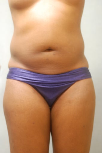 SmartLipo Abs & Love Handles 356690