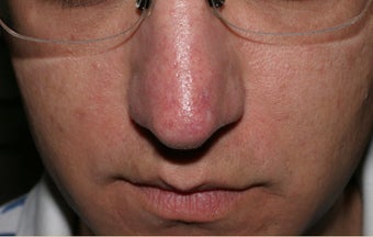 Vein treatment before 135906