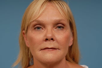 Sculptra, Restylane after 364322