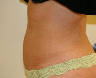 Mini-abdominoplasty after 493658