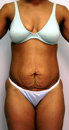 Abdominoplasty before 534256