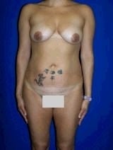 Tummy Tuck (Abdominoplasty) before 483695