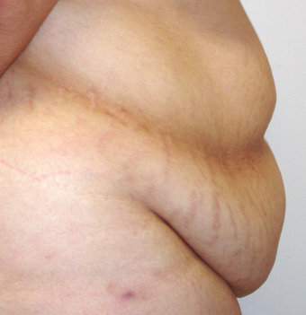 Tummy Tuck (Abdominoplasty) 142536